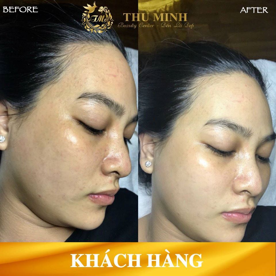 [Cập nhật 2020] Tiêm căng bóng da mặt giá bao nhiêu